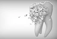 Implanturi pentru intreaga dantura – costuri si avantaje