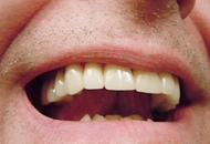 Avantajele unei coroane dentare
