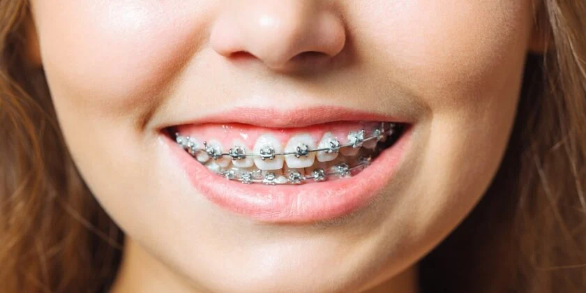 Avantajele montarii unui aparat dentar