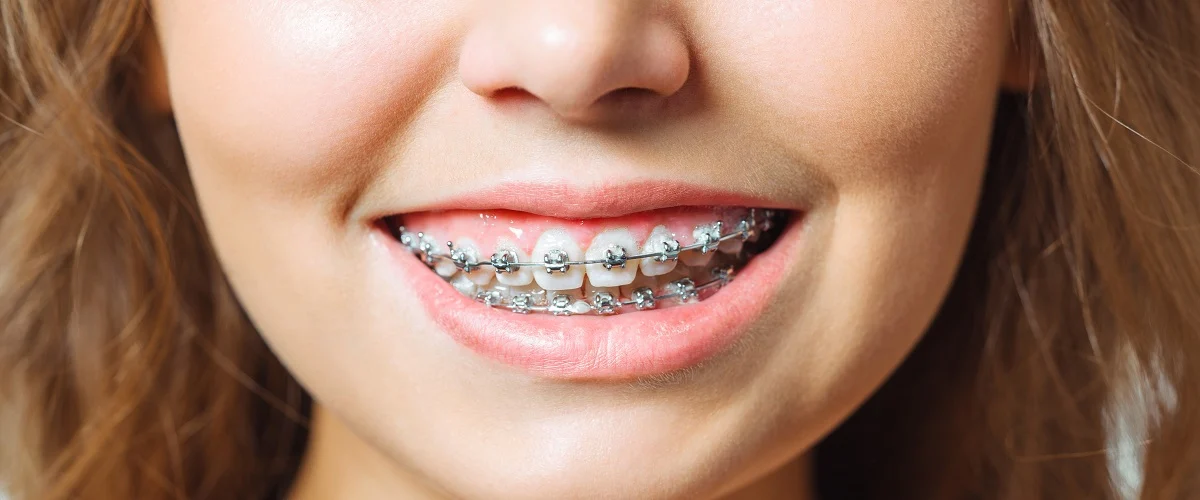 Avantajele montarii unui aparat dentar