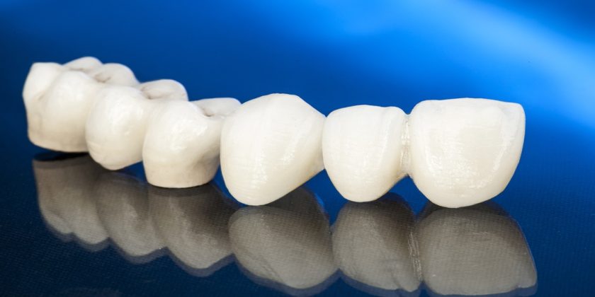 Avantajele unei coroane dentare