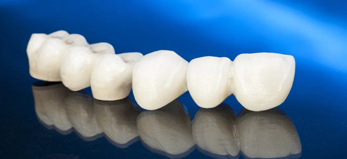 Avantajele unei coroane dentare
