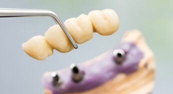 Cand este necesara o punte dentara