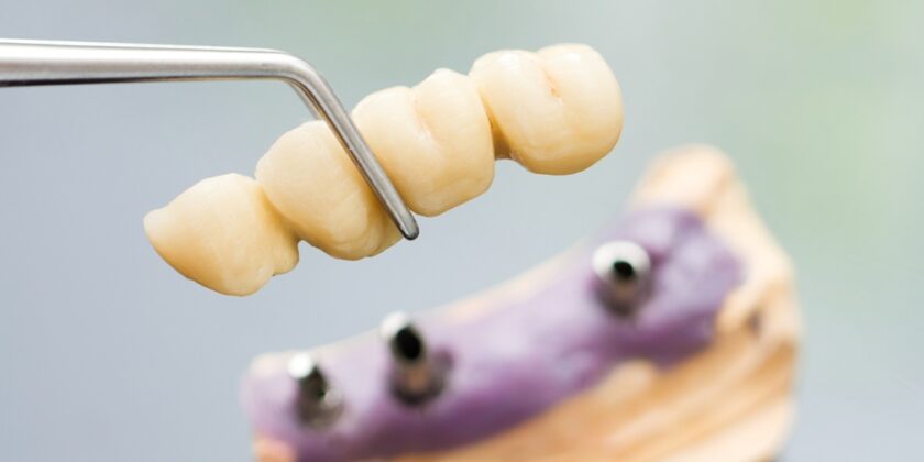 Cand este necesara o punte dentara