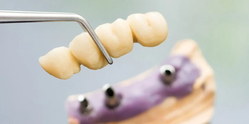 Cand este necesara o punte dentara