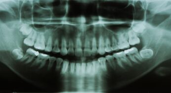 Care sunt beneficiile radiografiilor dentare