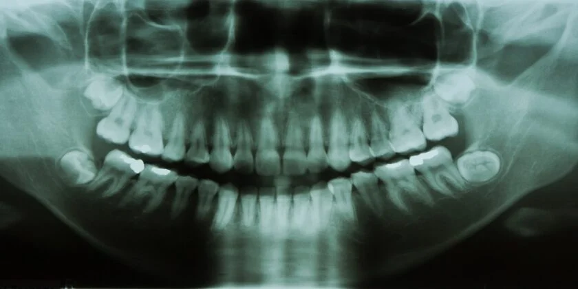 Care sunt beneficiile radiografiilor dentare