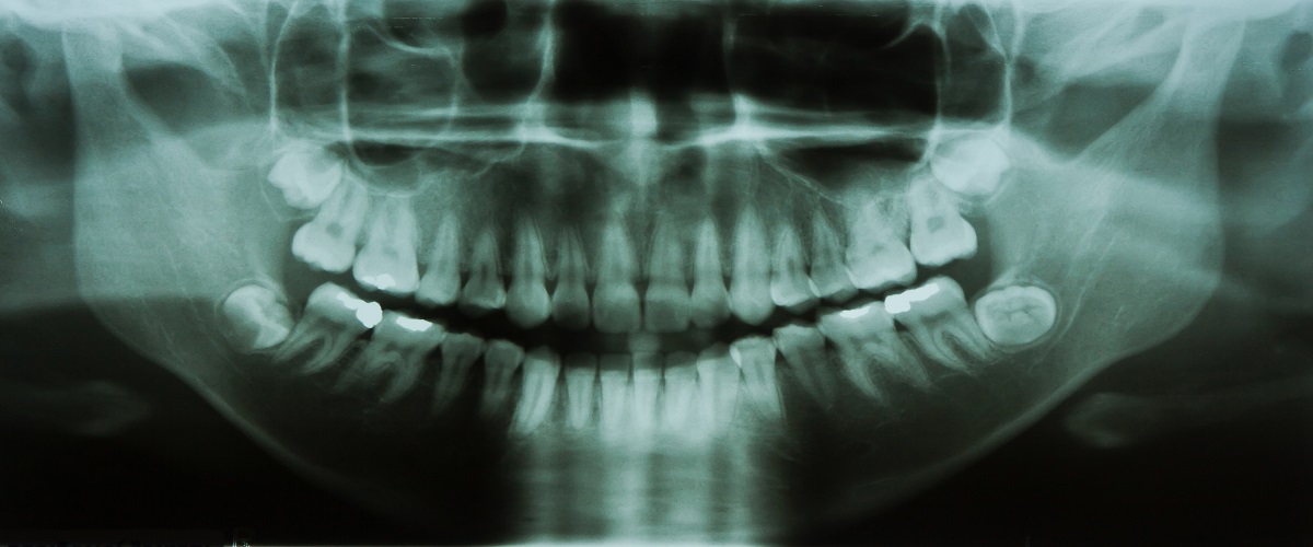 Care sunt beneficiile radiografiilor dentare