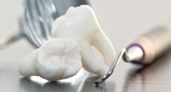 Extractii dentare in Bucuresti