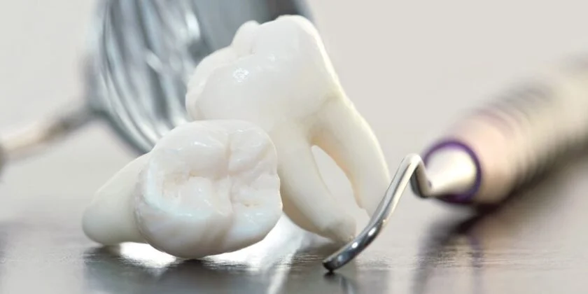 Extractii dentare in Bucuresti