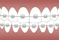 Avantajele purtarii unui aparat dentar ceramic