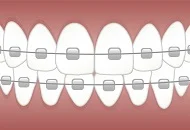 Avantajele purtarii unui aparat dentar ceramic