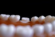 Avantajele montarii unei coroane dentare din zirconiu